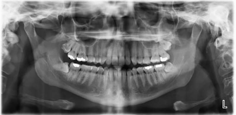 What Precautions Should Be Taken Before Teeth X-Ray?